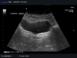 Ultrazvok mehurja - stresna inkontinenca